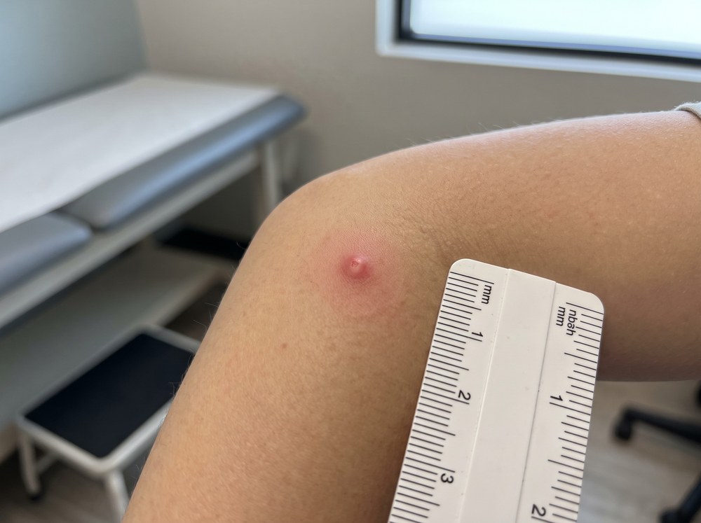 Close-up of a few scattered red raised skin bumps with no central puncture mark, consistent with beetle hair contact dermatitis